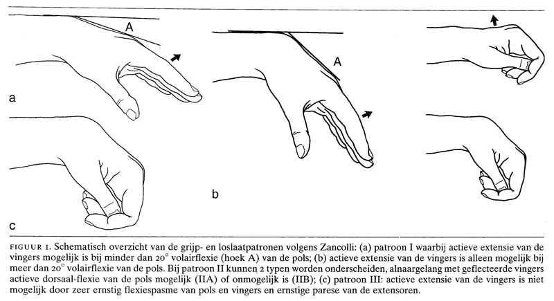 Operatieve Mogelijkheden Bij Spastisch Verlamde Arm En Hand Ntvg
