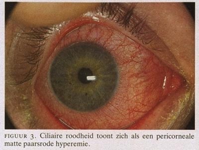 Het Rode Oog Diagnostiek En Behandeling Van Conjunctivitis Nederlands Tijdschrift Voor Geneeskunde