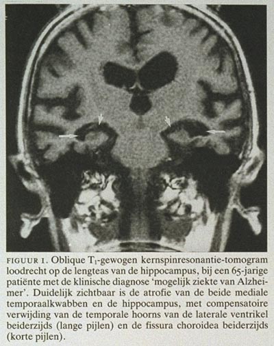 De Waarde Van De Nieuwe Diagnostische Technieken Bij De Ziekte Van ...