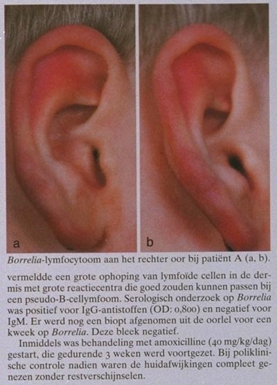 Borrelia Lymfocytoom Winteroren Bij Kinderen Nederlands Tijdschrift Voor Geneeskunde