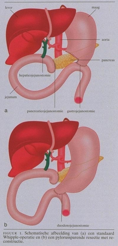 Whipple Operatie