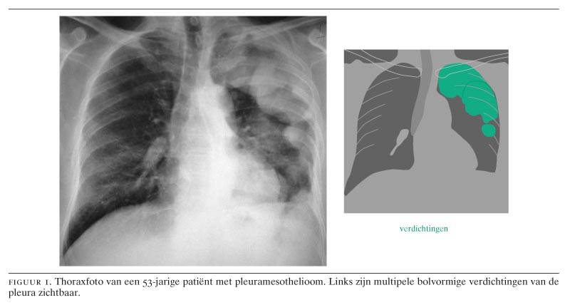 Diagnostiek van maligne pleuramesothelioom en asbestose - Nederlands Tijdschrift voor Geneeskunde