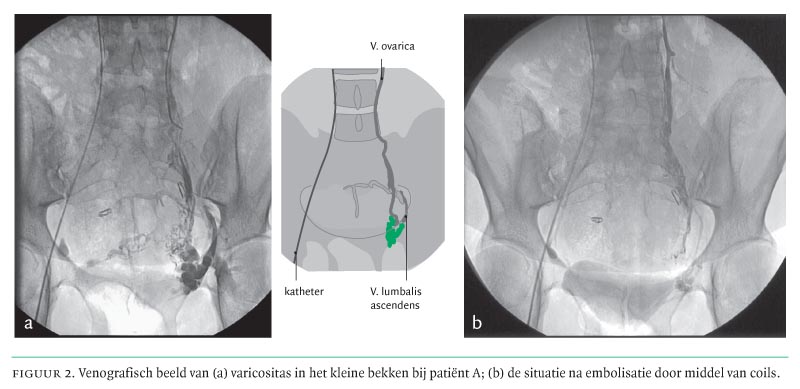 Vrouwen Met Onderbuikklachten En Met Atypische Varices Vulvavarices En Insufficiente Bekkenvenen Behandeling Door Embolisatie Nederlands Tijdschrift Voor Geneeskunde