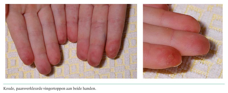 Diagnose in beeld (272). met verkleurde, pijnlijke handen | NTvG