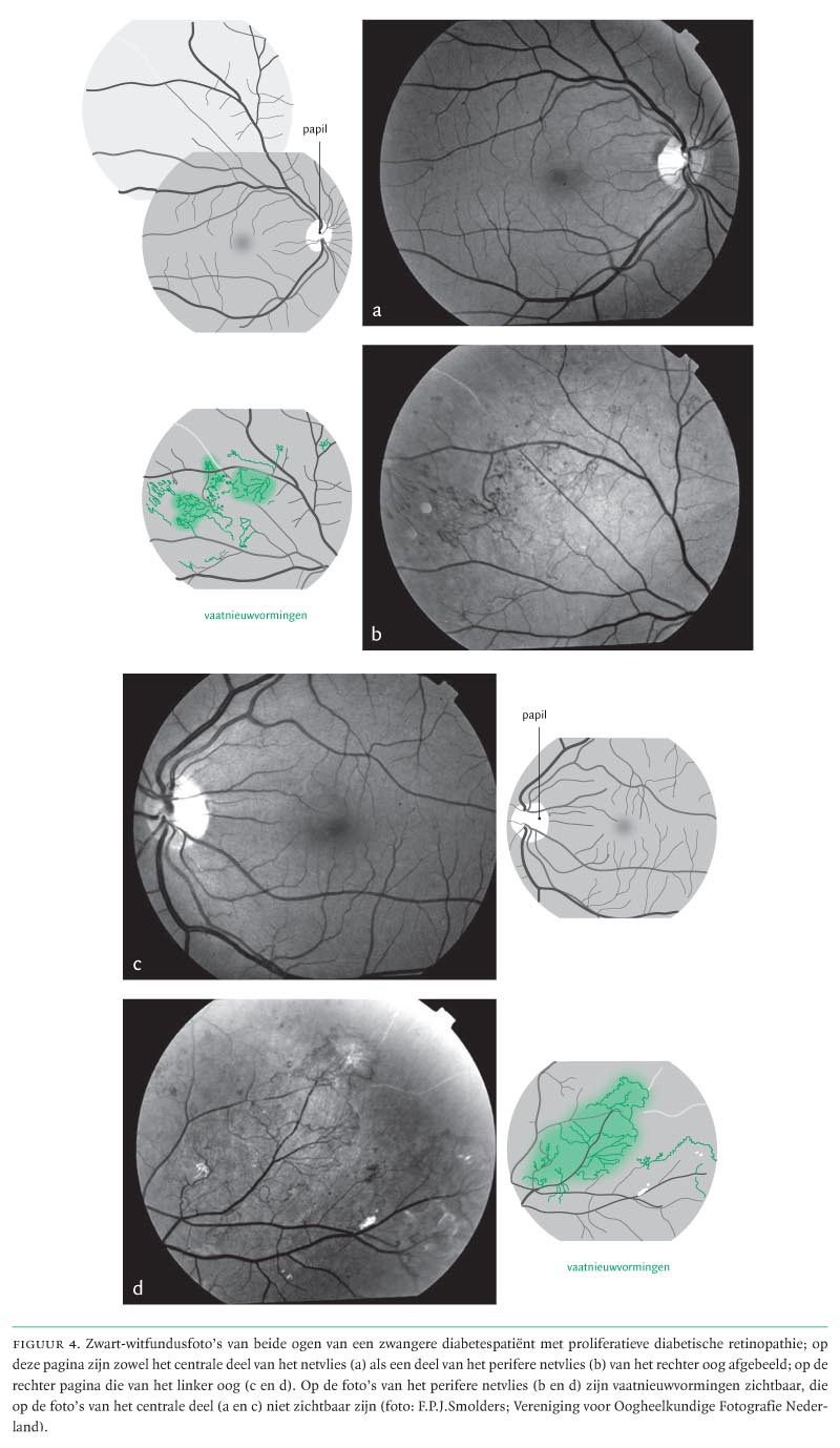 Diabetische Retinopathie Richtlijn