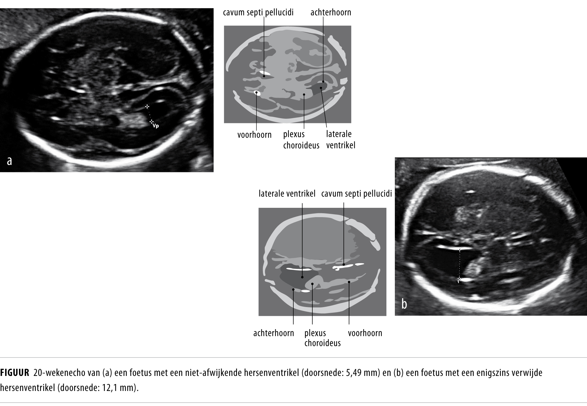 Ventriculomegalie Bij Zwangerschapsduur Van 20 Weken Nederlands Tijdschrift Voor Geneeskunde