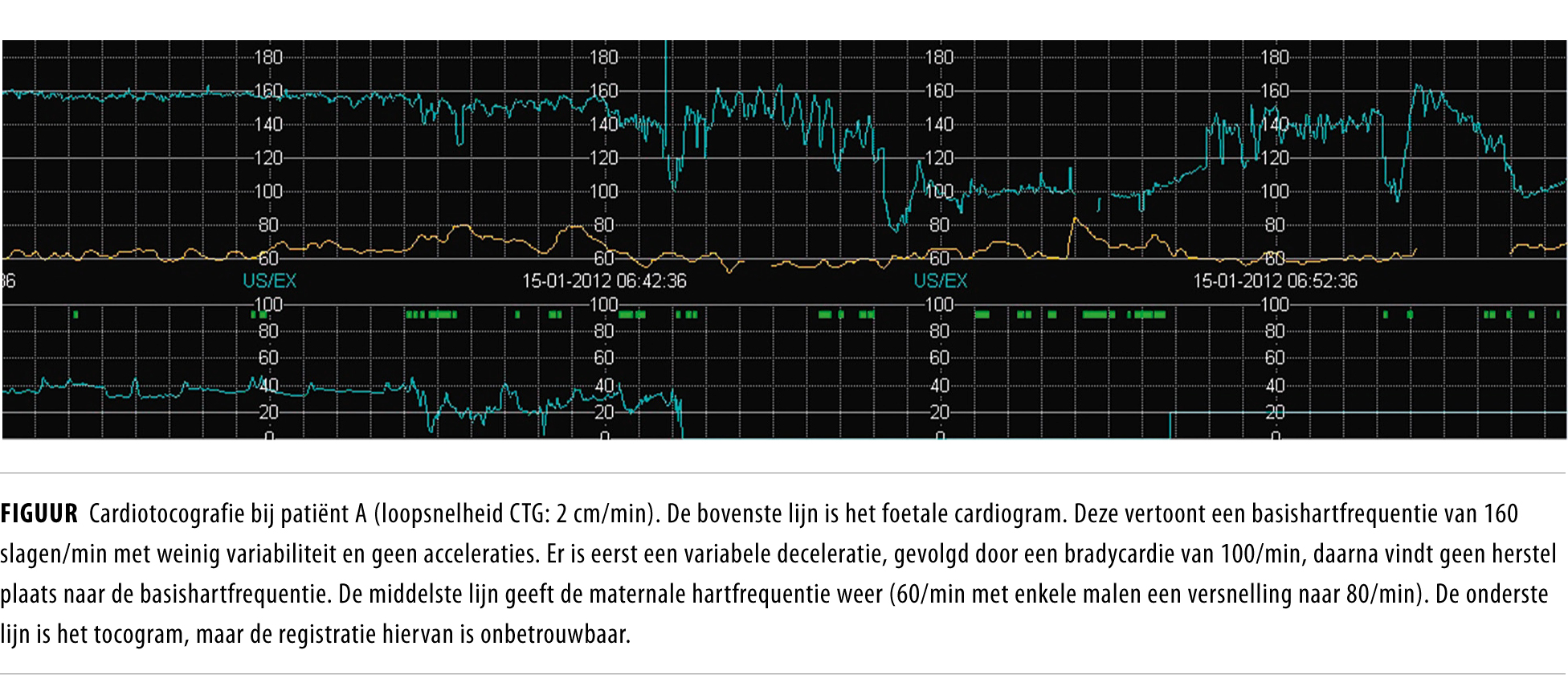 Shock In De Zwangerschap Nederlands Tijdschrift Voor Geneeskunde