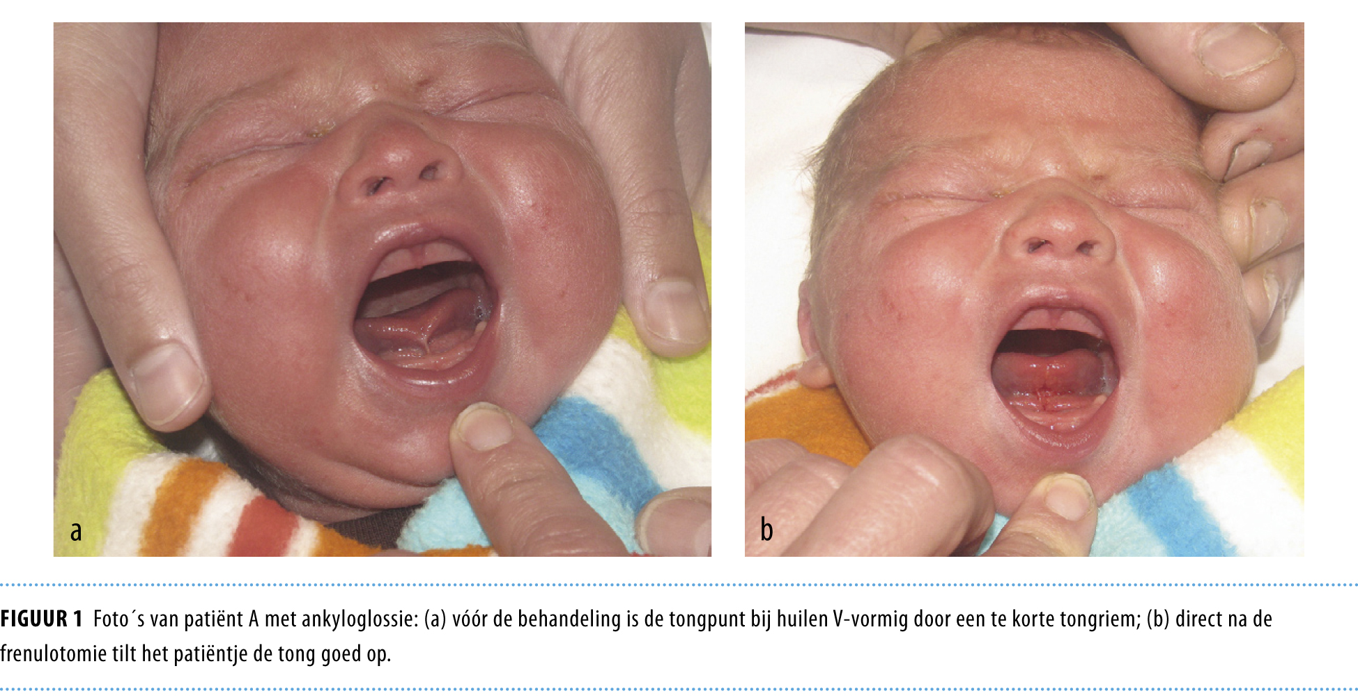 Problematische Borstvoeding Door Een Te Korte Tongriem Nederlands Tijdschrift Voor Geneeskunde