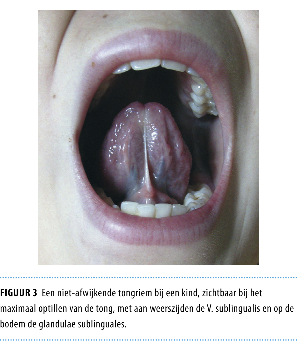 Problematische Borstvoeding Door Een Te Korte Tongriem Nederlands Tijdschrift Voor Geneeskunde