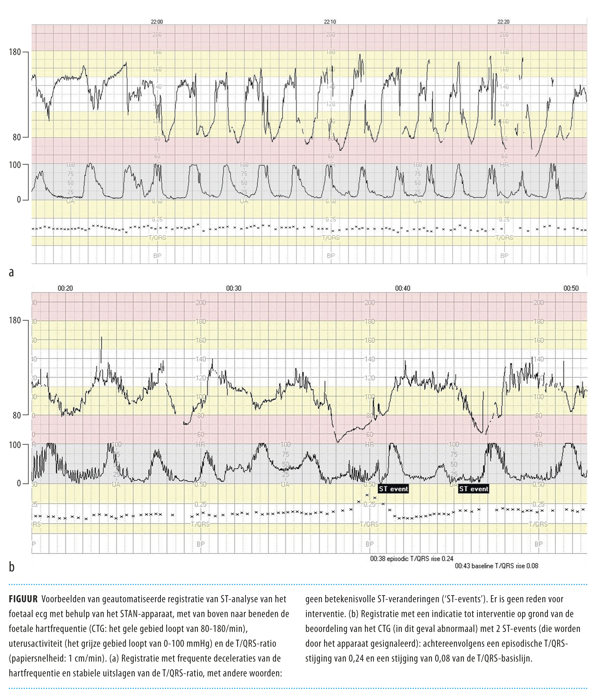 Foetale Bewaking Intra Partum Van Stethoscoop Naar St Analyse Van Het Ecg Nederlands Tijdschrift Voor Geneeskunde