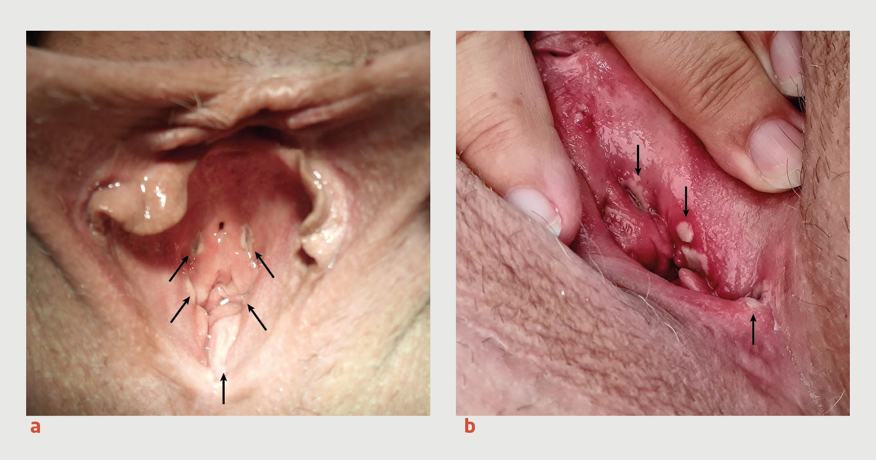 Klinische presentatie van monkeypox bij de vrouw NTvG foto