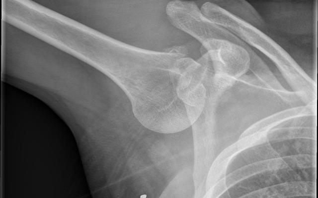 röntgenfoto van de rechter schouder van patiënt