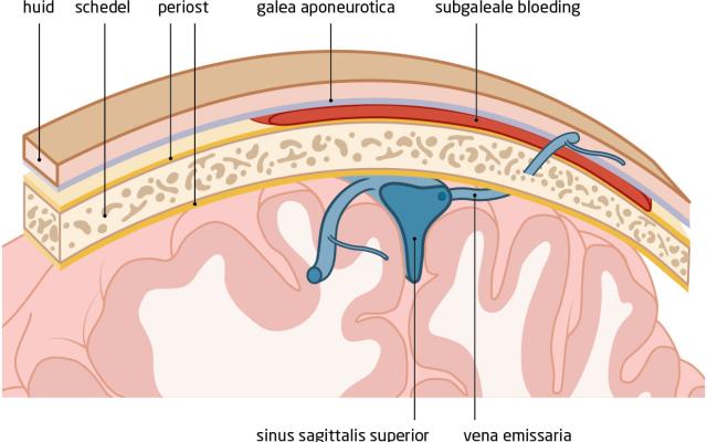 Figuur 3 | Subgaleale bloeding