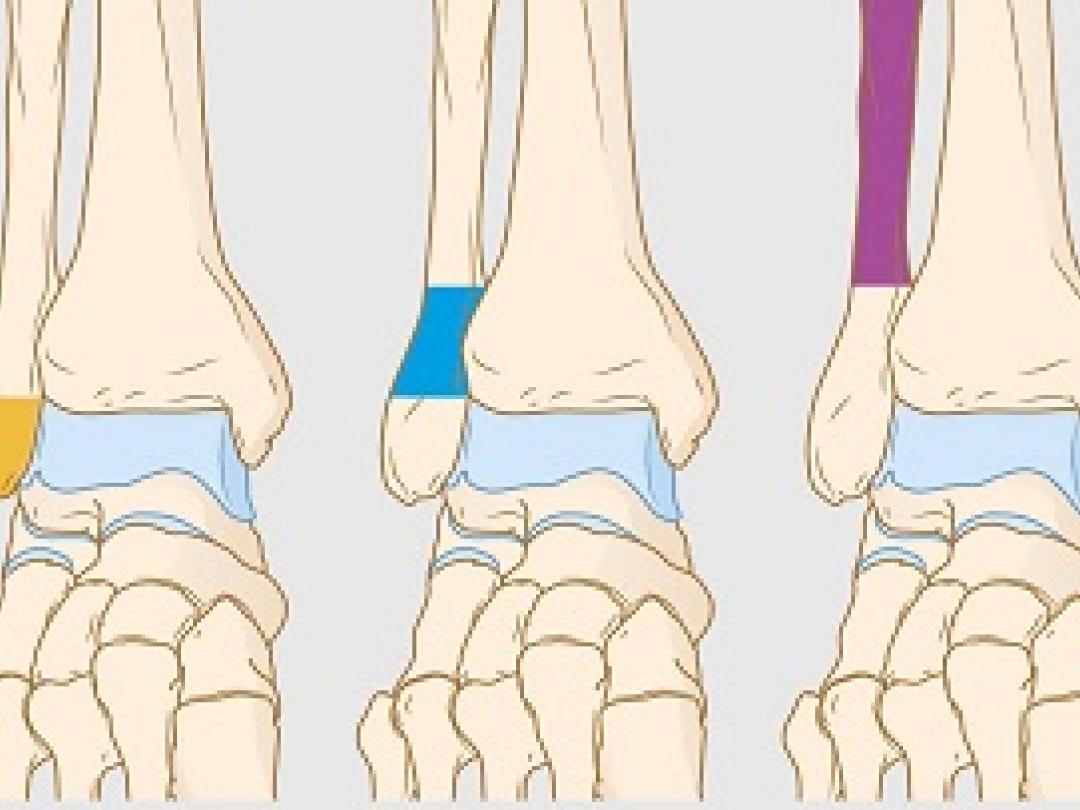 Kortere Immobilisatie Voor Weber B Enkelfracturen | NTVG