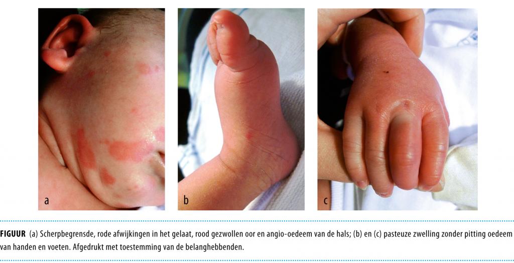 Mm warmte Signaal Een zuigeling met acute zwelling van handen en voeten | NTvG