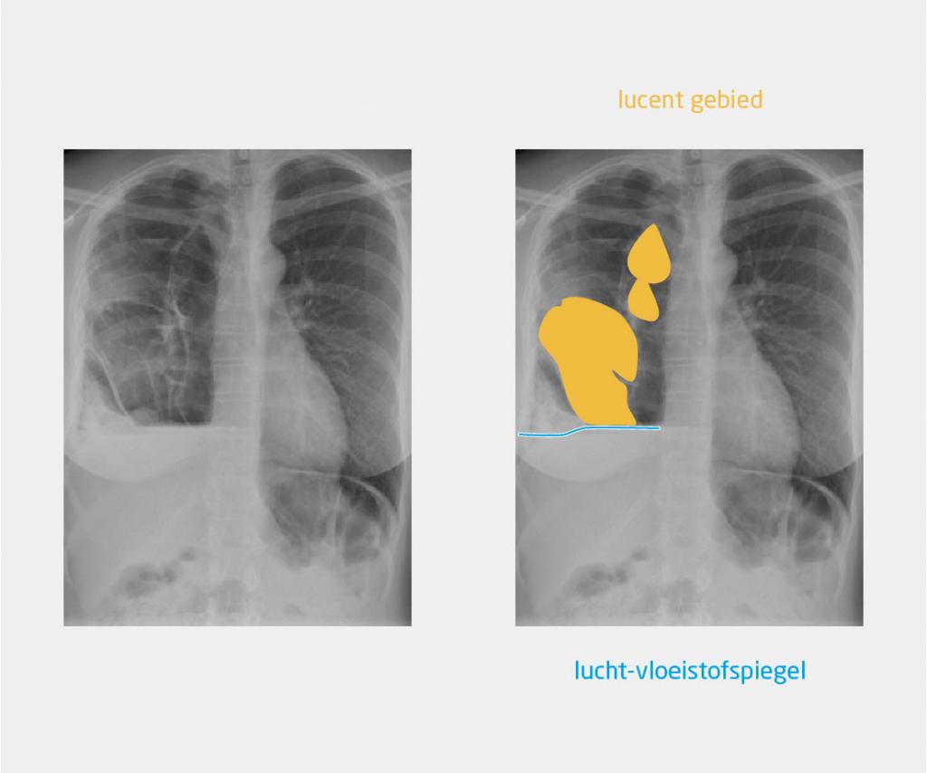 Figuur 1 | Anterieur-posterieure röntgenfoto van de thorax van patiënte