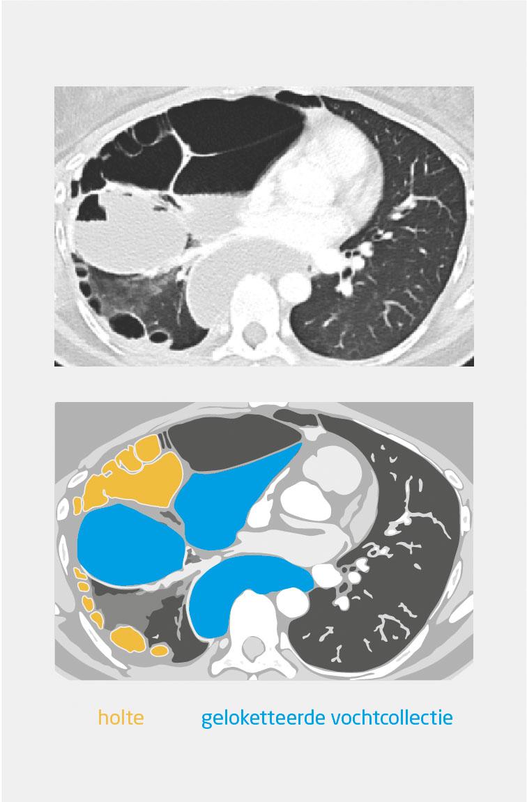 Figuur 2 | Transversale CT-opname van de thorax van patiënte