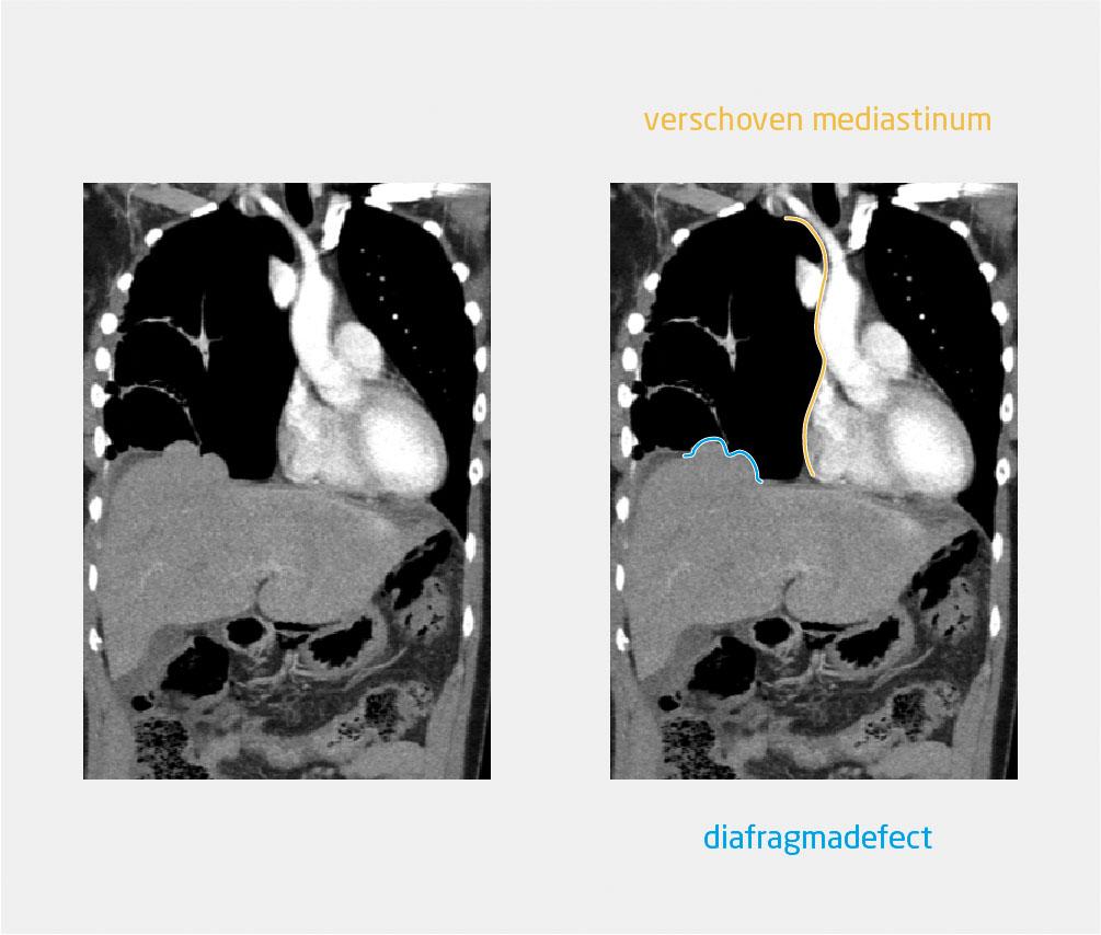 Figuur 3 | Coronale CT-opname van de thorax van patiënte