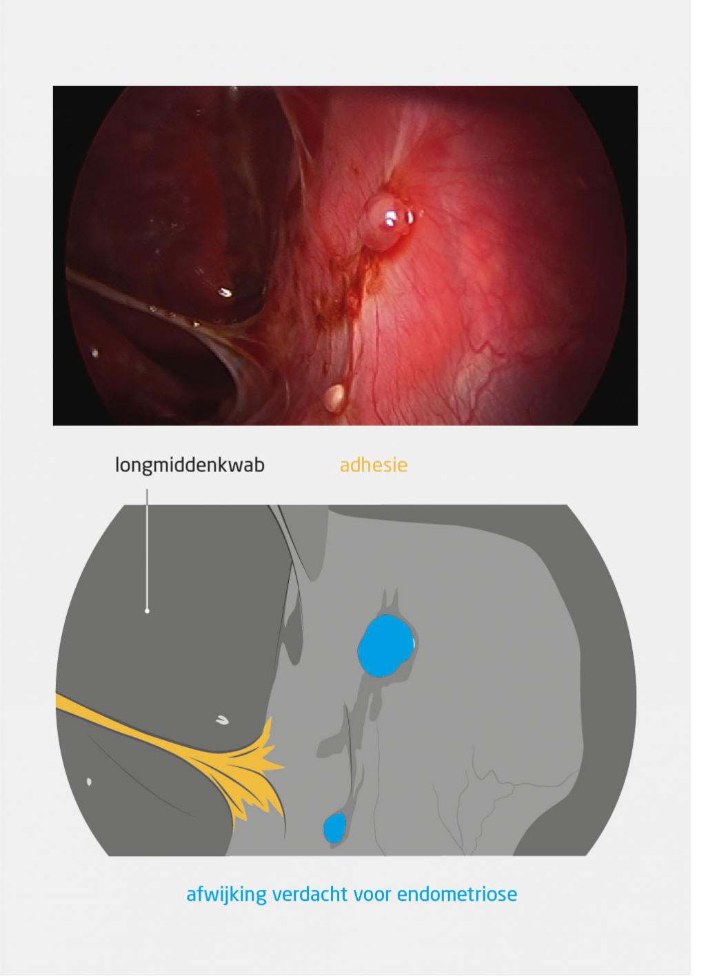 Figuur 4 | Peroperatief ventromediaal aanzicht van de pleura parietalis