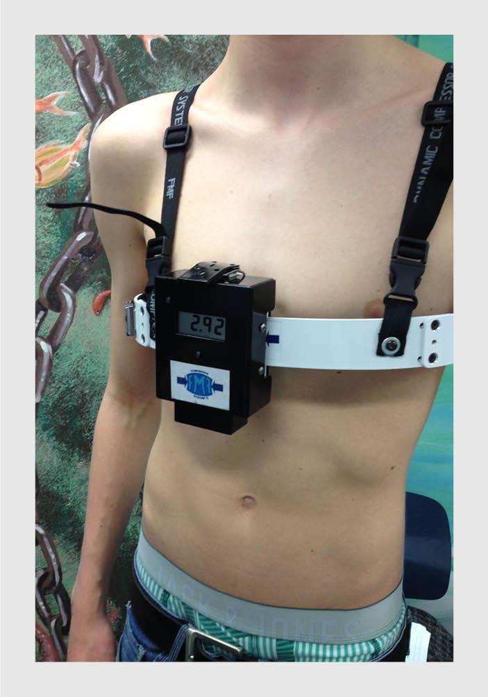 Dynamische-compressiebrace bij pectus carinatum