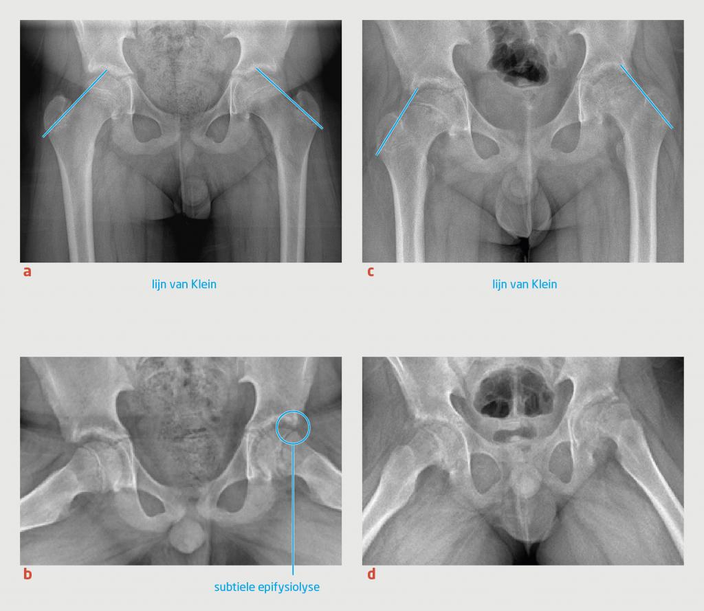 Figuur 4 | Progressie van de epifysiolyse van het caput ossis femoris bij een 12-jarige jongen