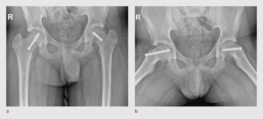 Figuur 5 | Operatief gefixeerde epifyse van het caput ossis femoris
