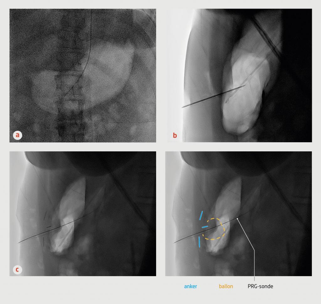 Figuur 1 | Stappen in de röntgengeleide plaatsing van een percutane voedingssonde
