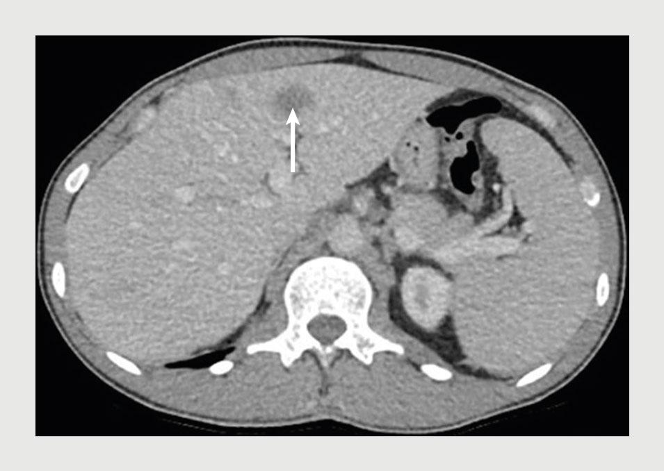 Figuur 1 | CT-scan van het abdomen