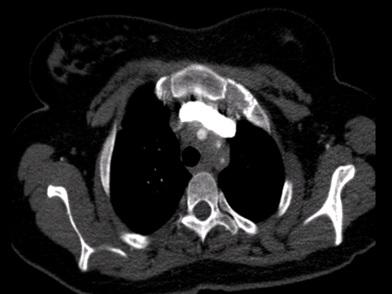 CT-angiografie met een transversale doorsnede van de aortaboog van patiënte