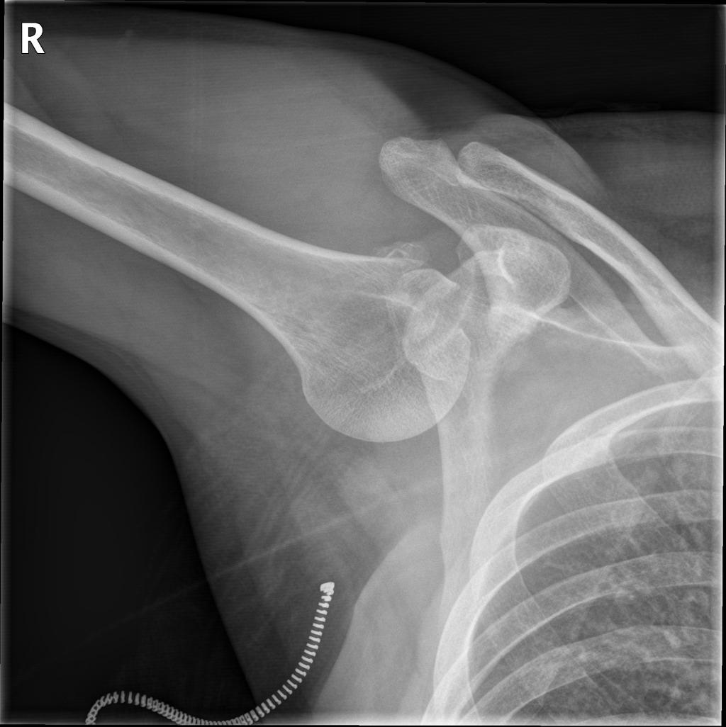 röntgenfoto van de rechter schouder van patiënt