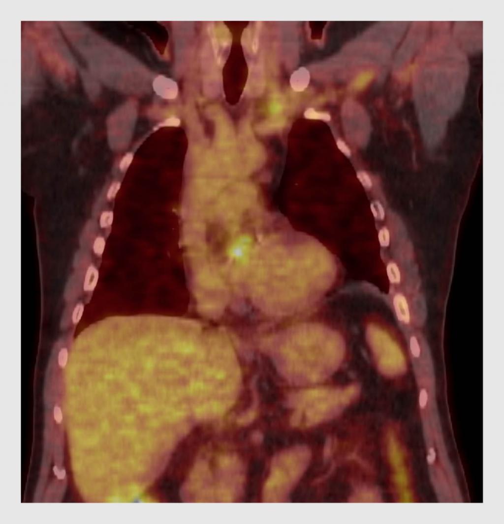 Figuur 1 | 18F-fluordeoxyglucose-PET/CT van patiënt A, een patiënt met een aortaklepbioprothese