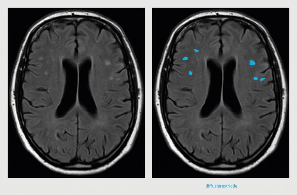 Figuur 2 | MRI van patiënt A na een episode van linkszijdige parese, paresthesie en dysartrie