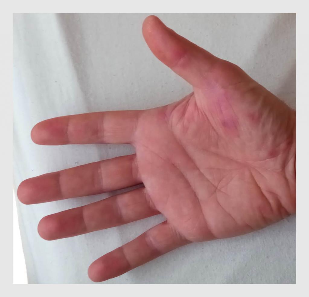 Figuur 3 | Huidafwijkingen op de rechter hand van patiënt B