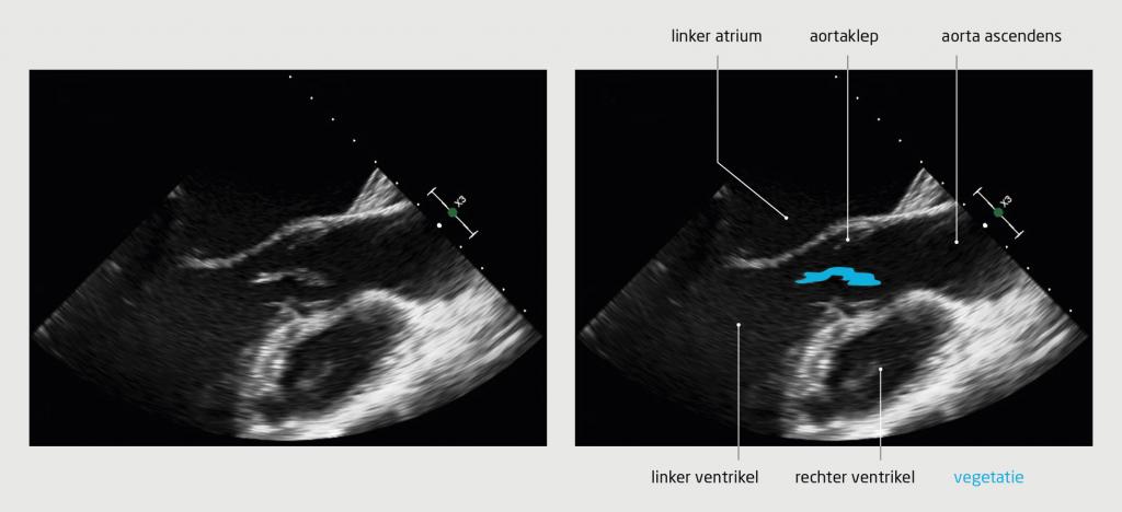 Figuur 4 | Transoesofageaal echocardiogram van patiënt C