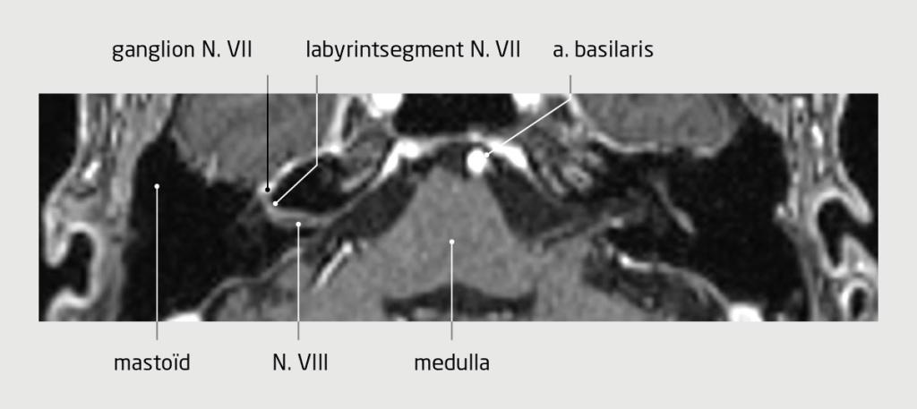 Figuur 1 | MRI-beeld van patiënt B