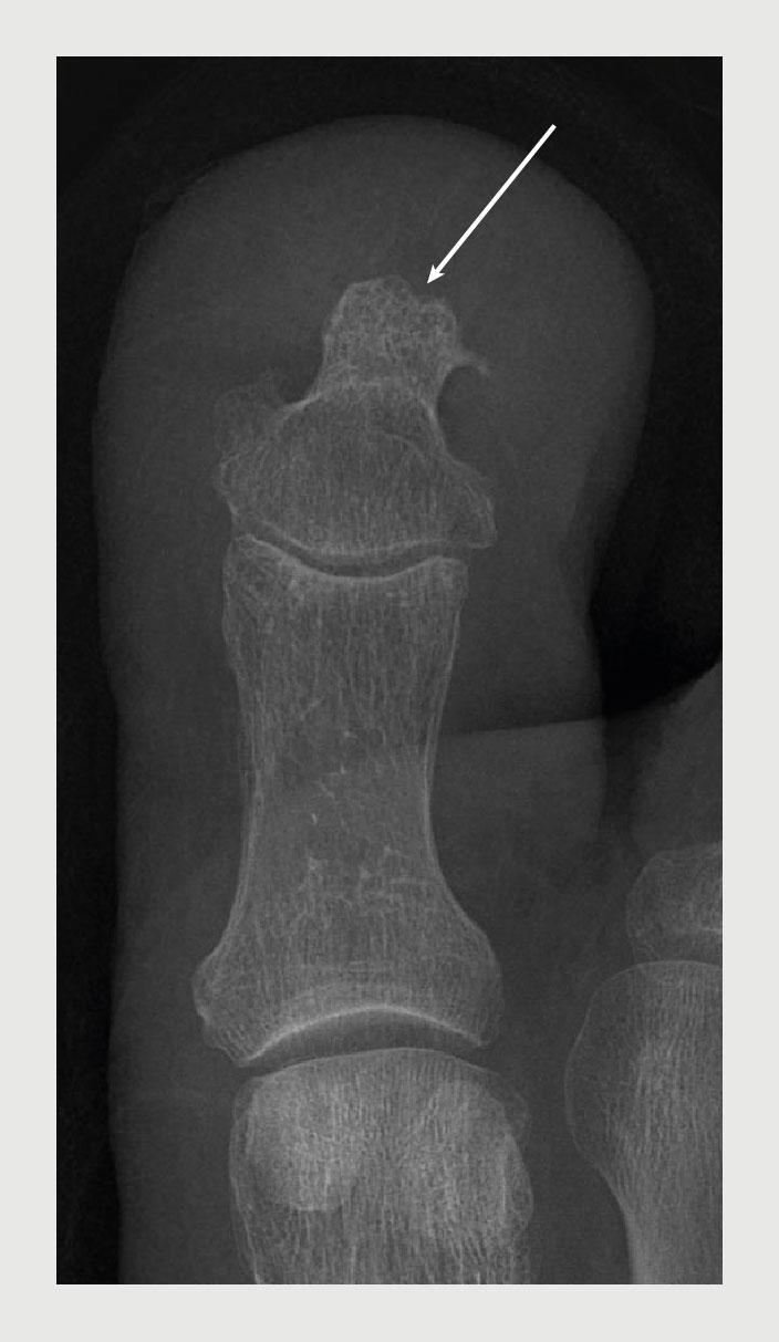 Figuur 4 | Röntgenfoto van patiënt C