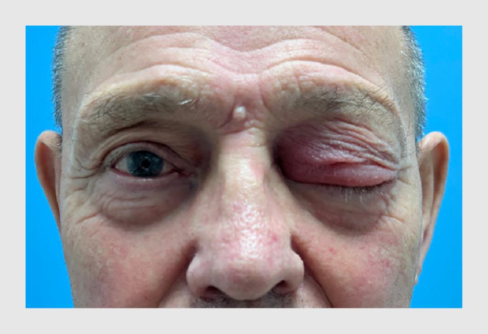 Figuur 1 | Zwelling van het ooglid van de patiënt