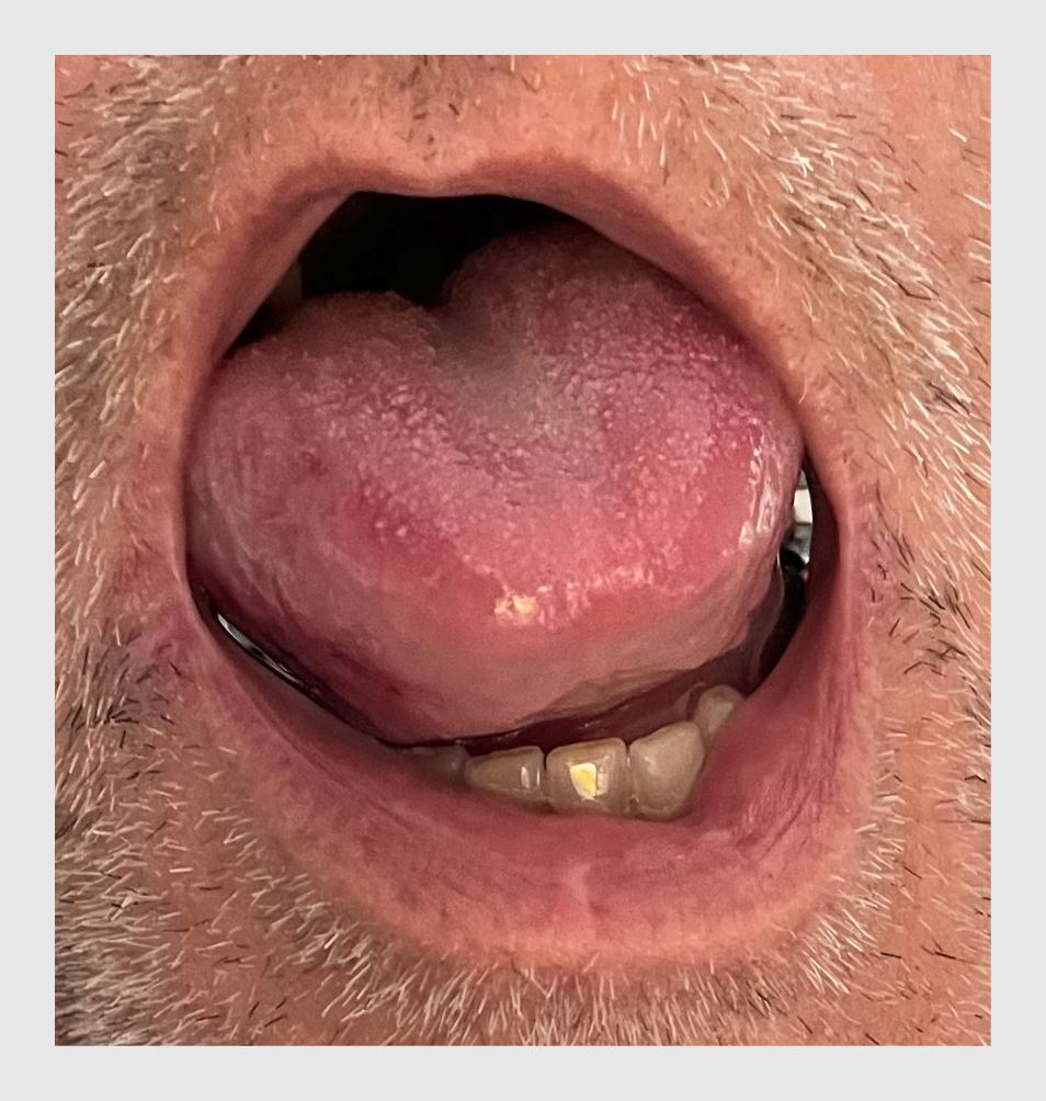 Figuur 3 | Angio-oedeem van de tong